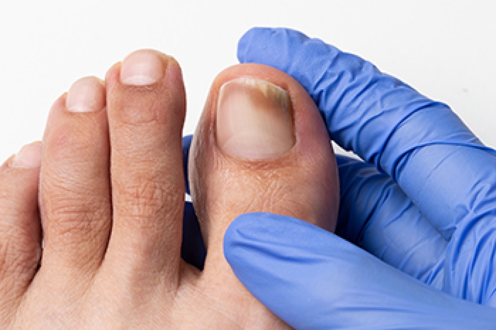 Stages Of Toenail Fungus