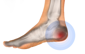 Pain in the bottom of your heel deals