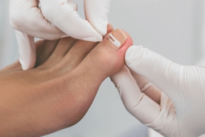 Chronic Ingrown Toenails