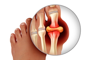 Can Children and Teenagers Suffer With Gout?