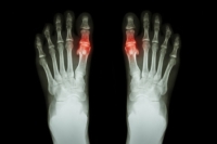 Managing Gout