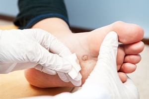How Did I Get This Plantar Wart?