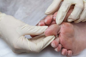 Caring for Diabetic Foot Infections