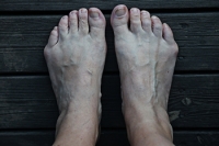 What to Know About Bunionette Deformity