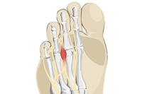 Pain From Morton’s Neuroma