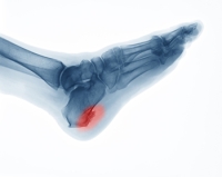 Definition and Root Causes of Heel Spurs
